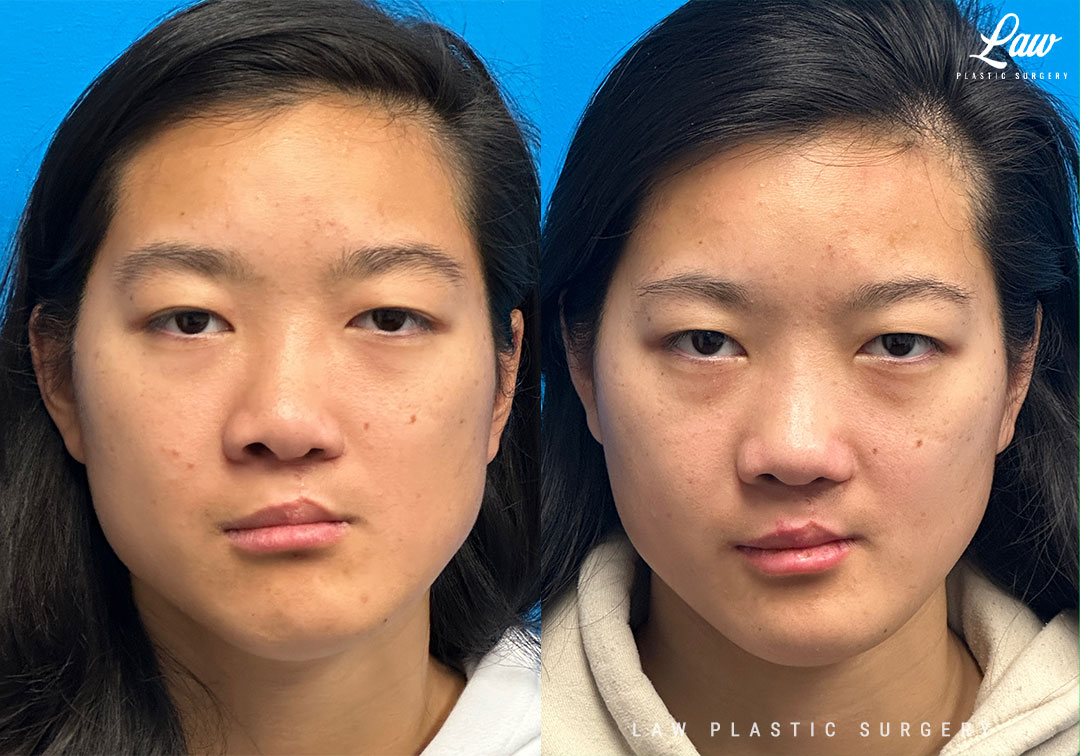 Cleft Rhinoplasty (Cleft Nose Surgery) Before & After Photo. Surgery performed in Dallas, TX at Law Plastic Surgery.