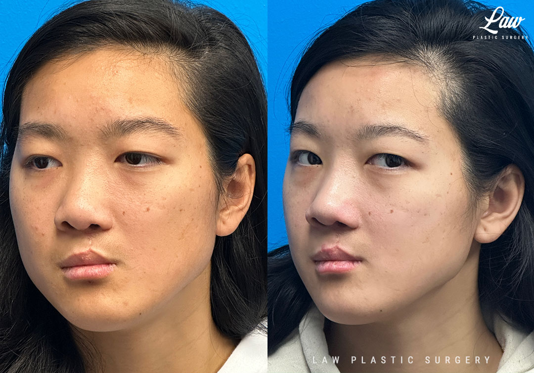 Cleft Rhinoplasty (Cleft Nose Surgery) Before & After Photo. Surgery performed in Dallas, TX at Law Plastic Surgery.