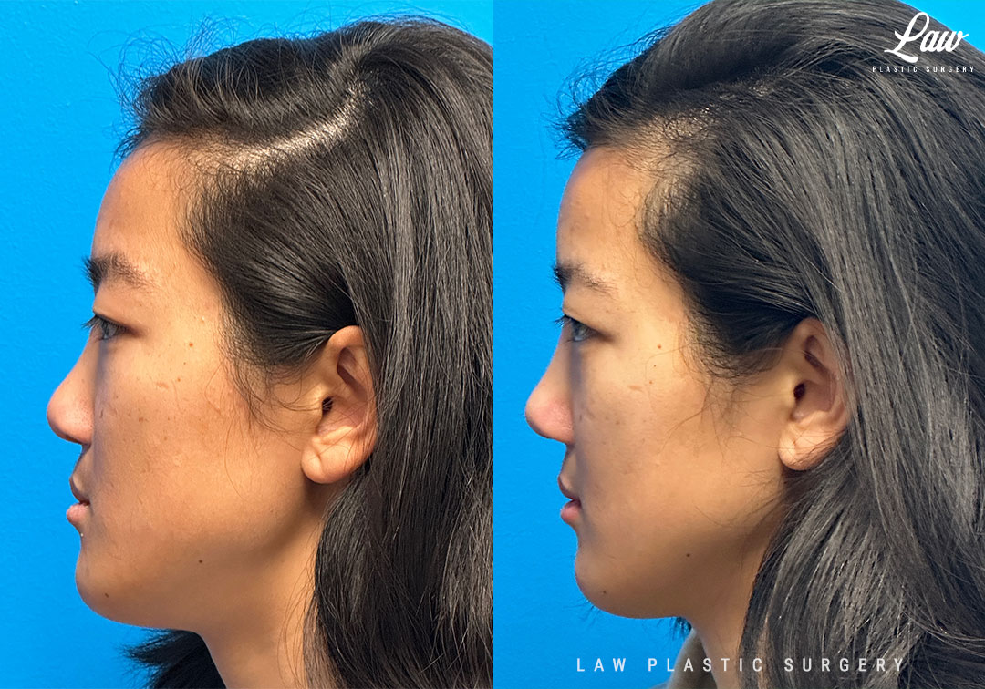Cleft Rhinoplasty (Cleft Nose Surgery) Before & After Photo. Surgery performed in Dallas, TX at Law Plastic Surgery.