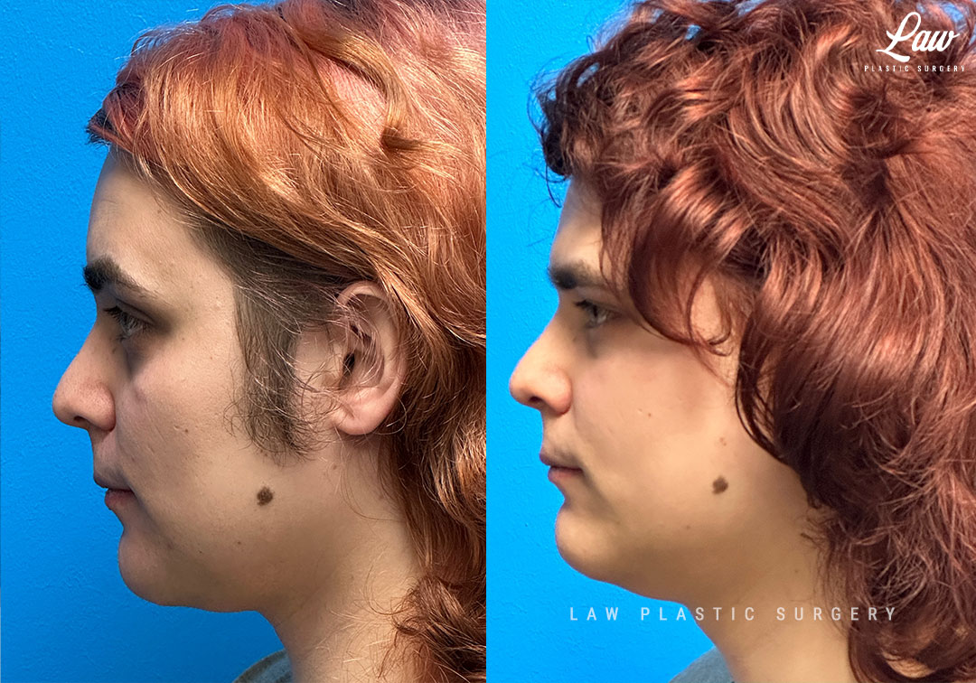 Facial Feminization Before & After Photo. Surgery performed in Dallas, TX at Law Plastic Surgery.