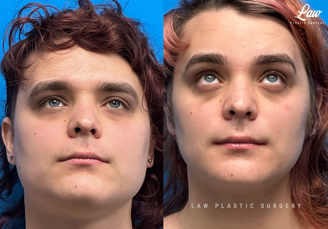 Facial Feminization Before & After Photo. Surgery performed in Dallas, TX at Law Plastic Surgery.