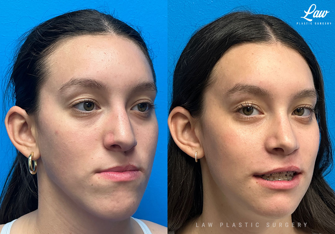 Jaw Surgery Before and After Photo. Surgery performed in Dallas, TX at Law Plastic Surgery.