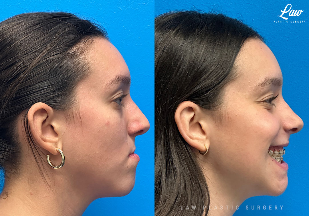 Jaw Surgery Before and After Photo. Surgery performed in Dallas, TX at Law Plastic Surgery.