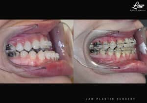 Jaw Surgery Before and After Photo. Surgery performed in Dallas, TX at Law Plastic Surgery.
