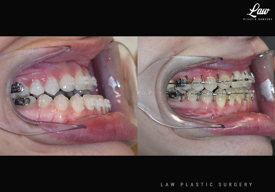 Jaw Surgery Before and After Photo. Surgery performed in Dallas, TX at Law Plastic Surgery.