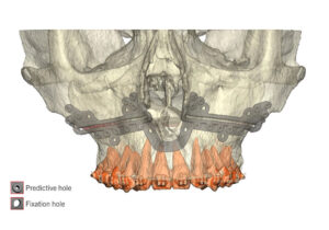 Jaw Surgery Before and After Photo. Surgery performed in Dallas, TX at Law Plastic Surgery.
