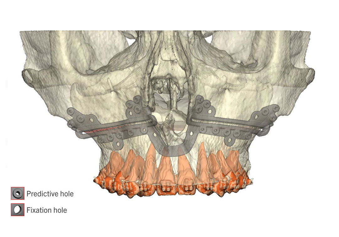 Jaw Surgery Before and After Photo. Surgery performed in Dallas, TX at Law Plastic Surgery.