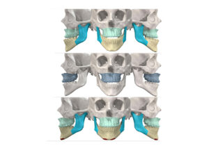 Jaw Surgery Before and After Photo. Surgery performed in Dallas, TX at Law Plastic Surgery.