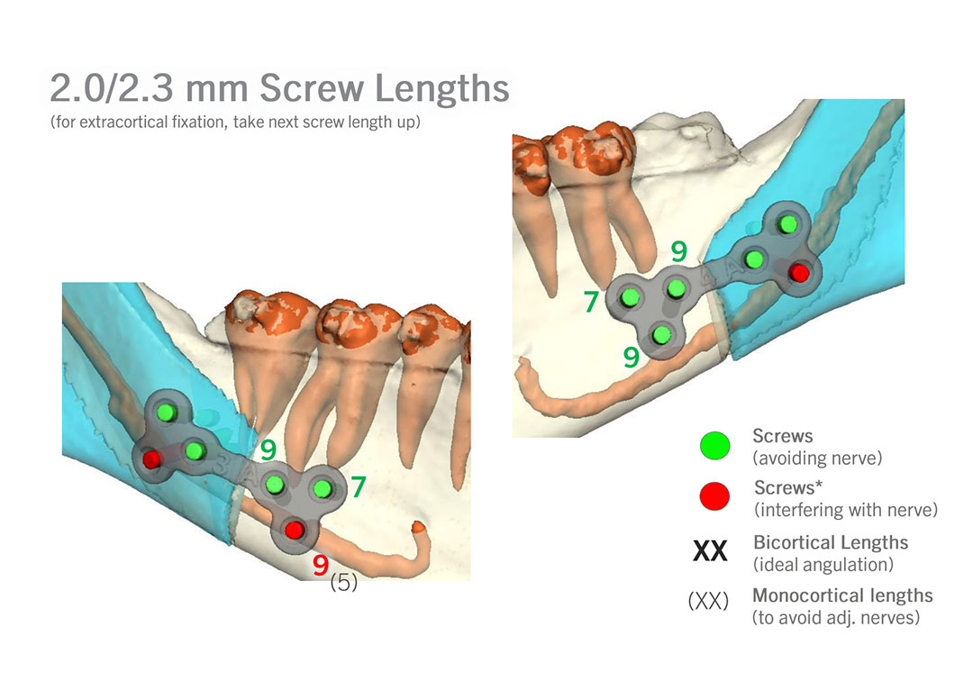 Jaw Surgery Before and After Photo. Surgery performed in Dallas, TX at Law Plastic Surgery.