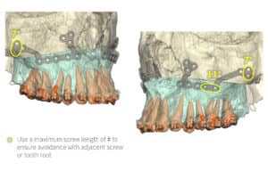 Jaw Surgery Before and After Photo. Surgery performed in Dallas, TX at Law Plastic Surgery.