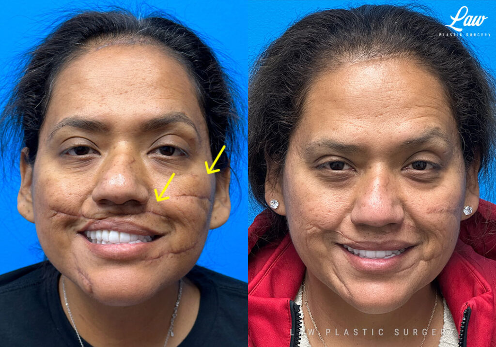 Scar Revision Before After Photos Law Plastic Surgery
