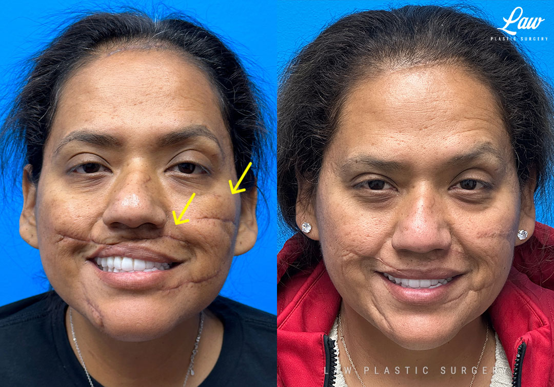 Scar Revision Before and After Photo. Surgery performed in Dallas, TX at Law Plastic Surgery.