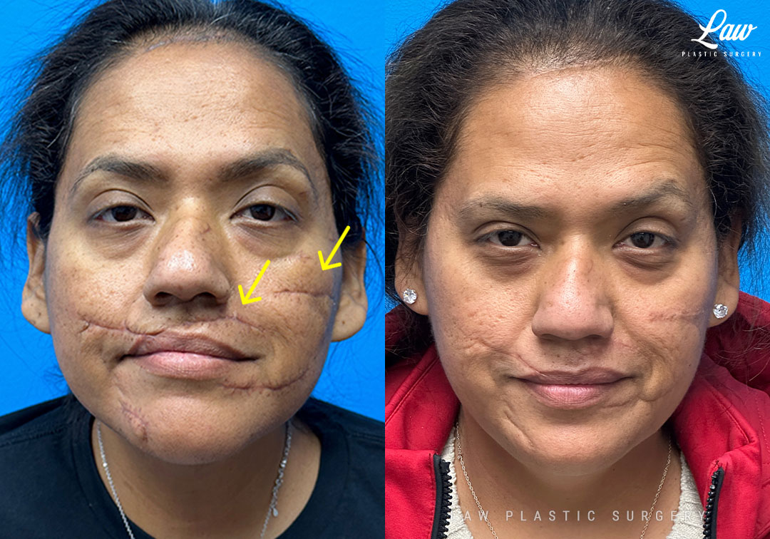 Scar Revision Before and After Photo. Surgery performed in Dallas, TX at Law Plastic Surgery.