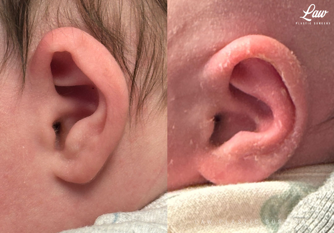 Ear Molding Before and After Photo. Surgery performed in Dallas, TX at Law Plastic Surgery.