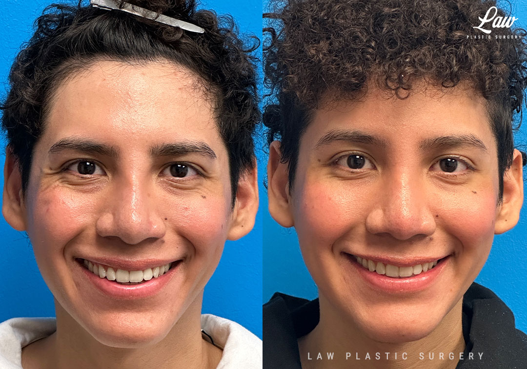 Facial Feminization Before & After Photo. Surgery performed in Dallas, TX at Law Plastic Surgery.