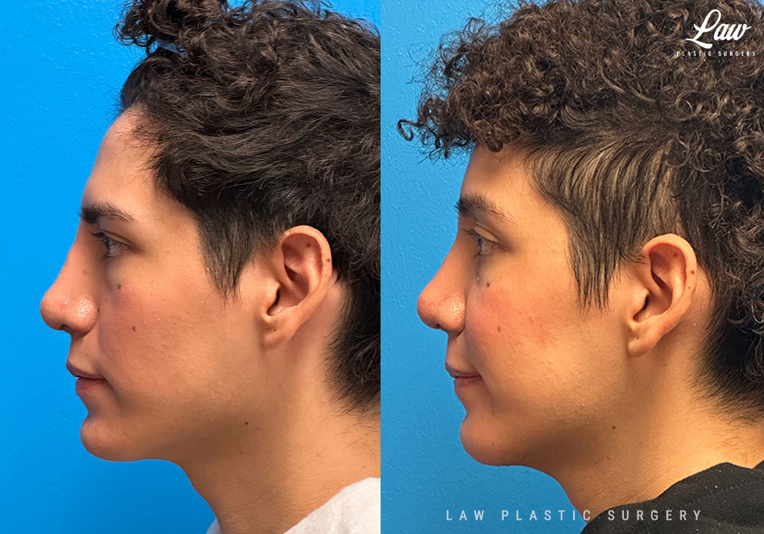Facial Feminization Before & After Photo. Surgery performed in Dallas, TX at Law Plastic Surgery.