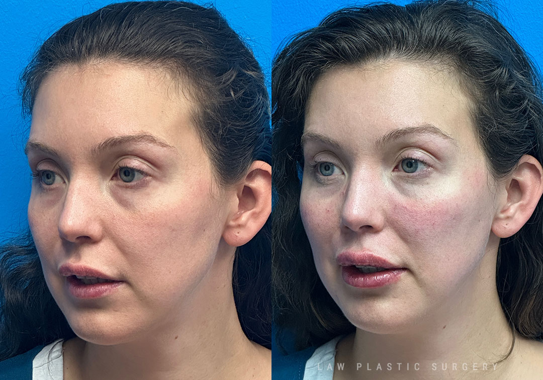 Injectables Before & After Photo. Procedure performed in Dallas, TX at Law Plastic Surgery.