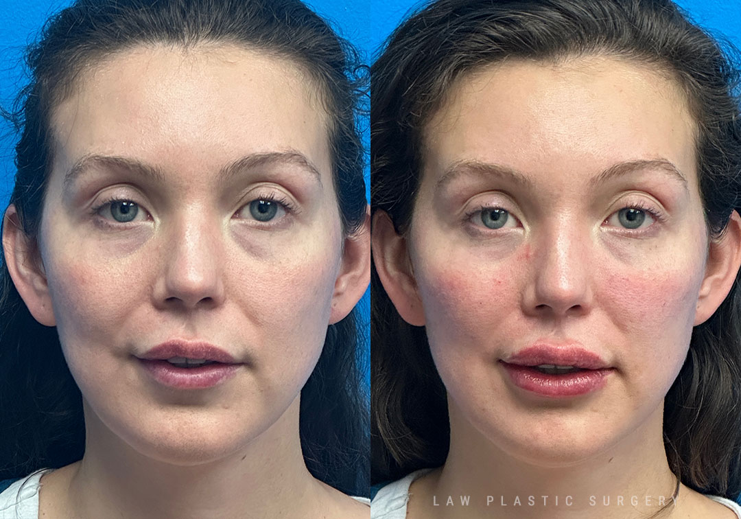 Injectables Before & After Photo. Procedure performed in Dallas, TX at Law Plastic Surgery.