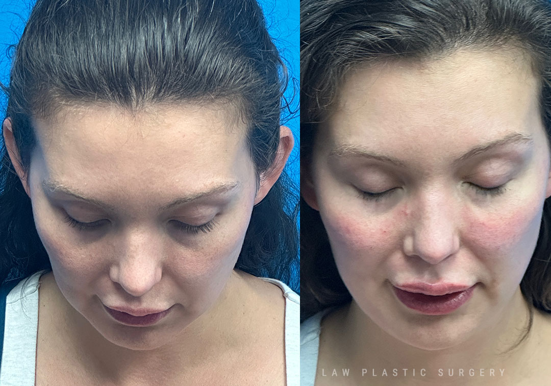 Injectables Before & After Photo. Procedure performed in Dallas, TX at Law Plastic Surgery.