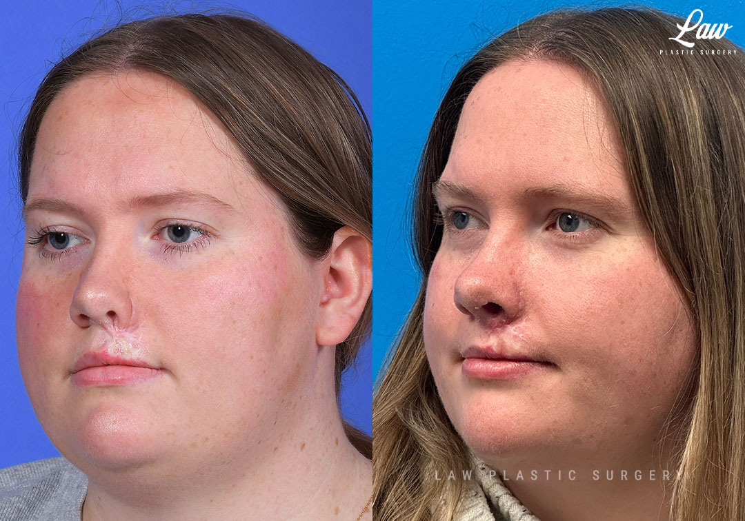 Scar Revision Before & After Photo. Surgery performed in Dallas, TX at Law Plastic Surgery.
