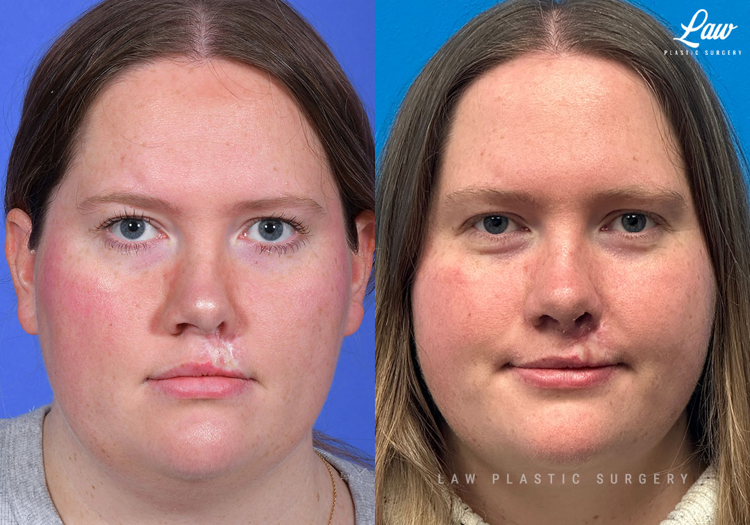Scar Revision Before & After Photo. Surgery performed in Dallas, TX at Law Plastic Surgery.
