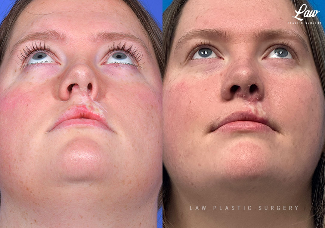 Scar Revision Before & After Photo. Surgery performed in Dallas, TX at Law Plastic Surgery.
