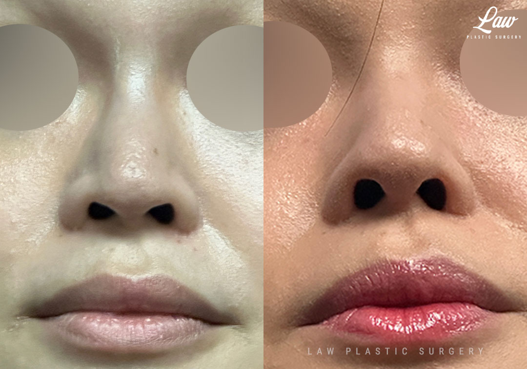 Revision Rhinoplasty Before & After Photo. Surgery performed in Dallas, TX at Law Plastic Surgery.