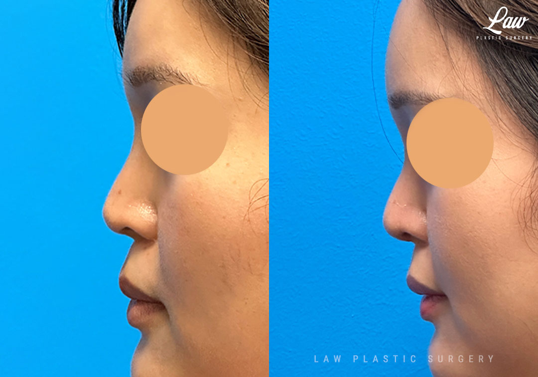 Revision Rhinoplasty Before & After Photo. Surgery performed in Dallas, TX at Law Plastic Surgery.