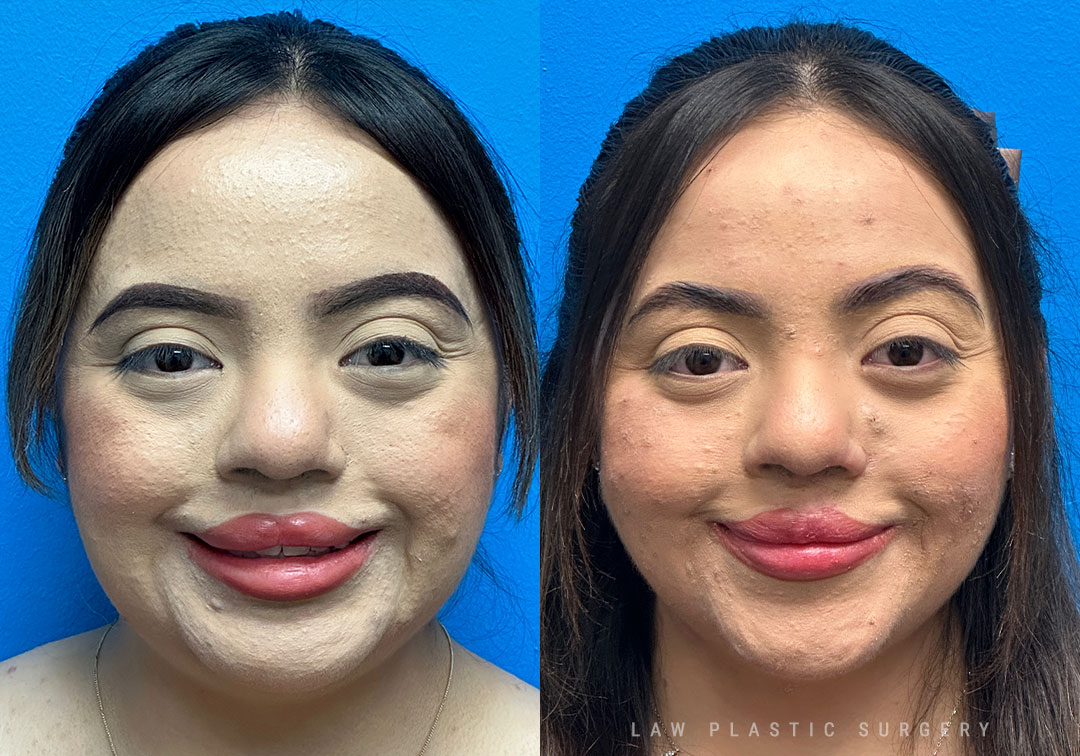 Cleft Lip Repair, Secondary and Adult Before & After Photo. Surgery performed in Dallas, TX at Law Plastic Surgery.