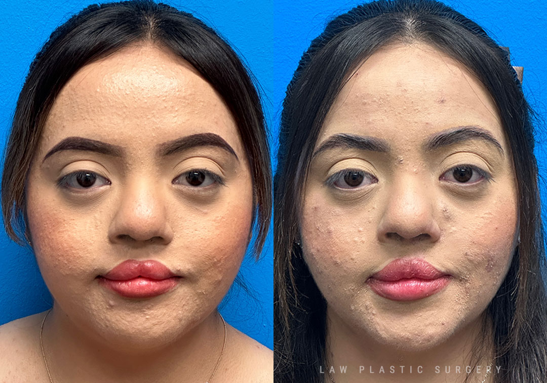 Cleft Lip Repair, Secondary and Adult Before & After Photo. Surgery performed in Dallas, TX at Law Plastic Surgery.