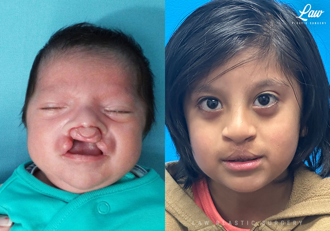 Cleft Lip Repair Before & After Photo. Surgery performed in Dallas, TX at Law Plastic Surgery.