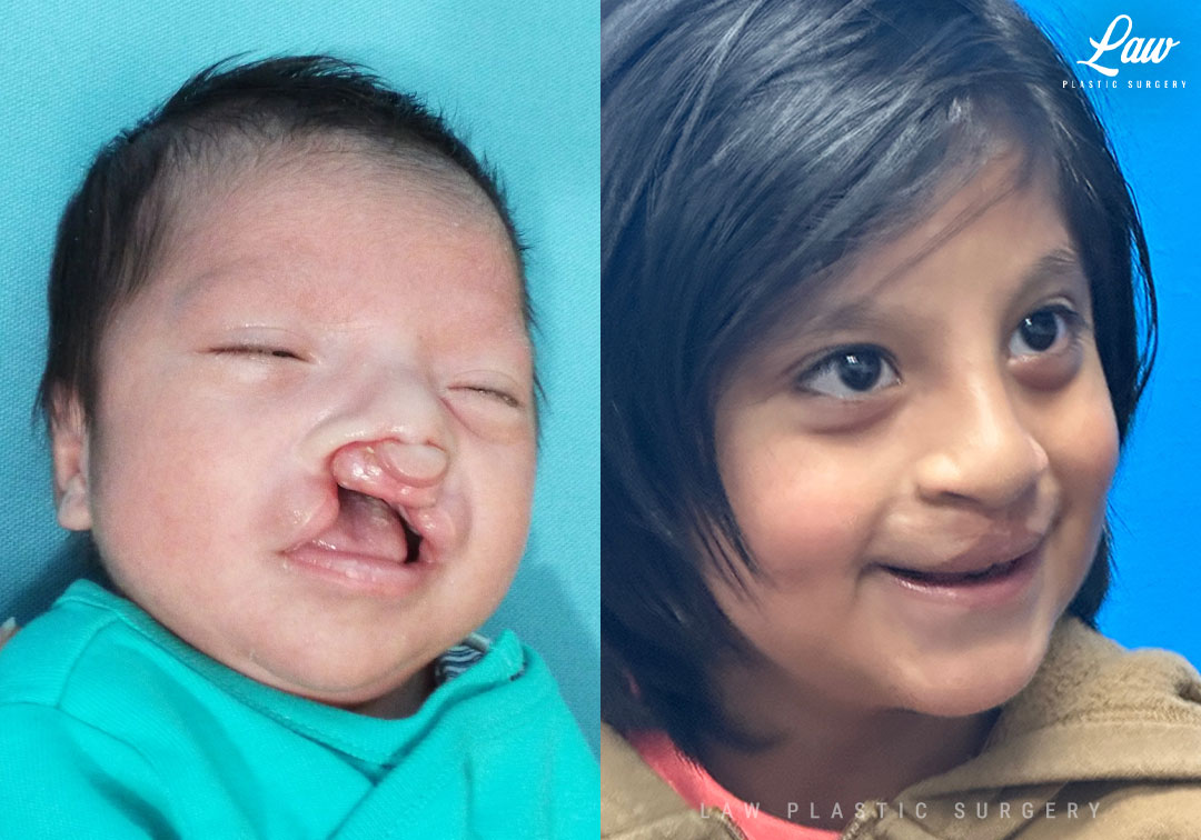 Cleft Lip Repair Before & After Photo. Surgery performed in Dallas, TX at Law Plastic Surgery.
