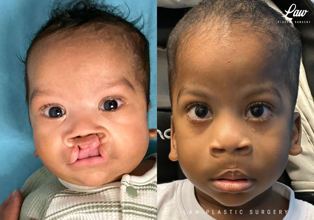 Cleft Lip Repair Before & After Photo. Surgery performed in Dallas, TX at Law Plastic Surgery.