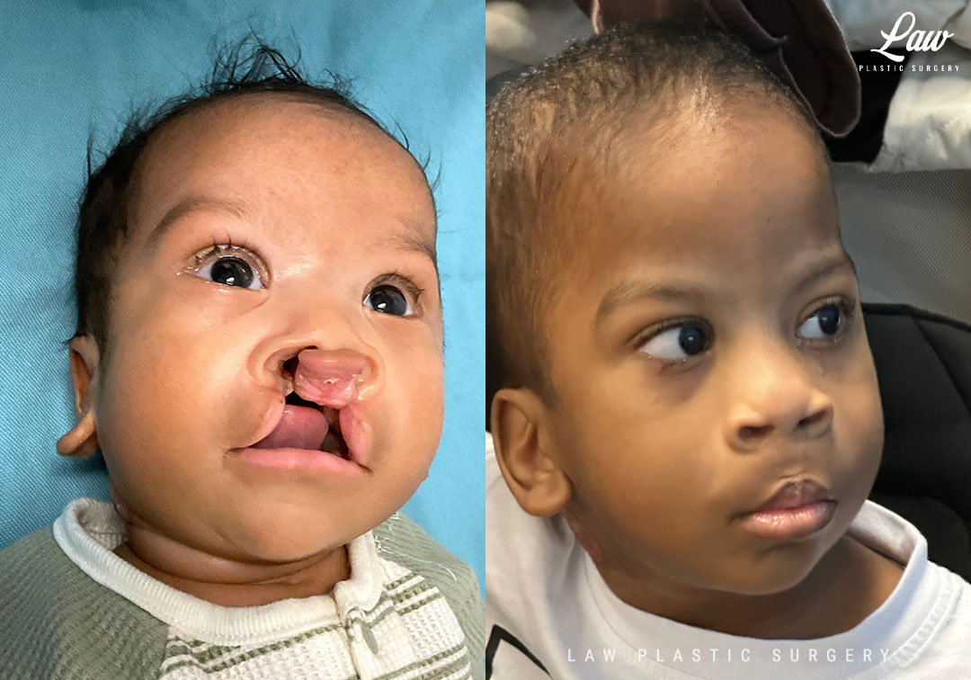 Cleft Lip Repair Before & After Photo. Surgery performed in Dallas, TX at Law Plastic Surgery.