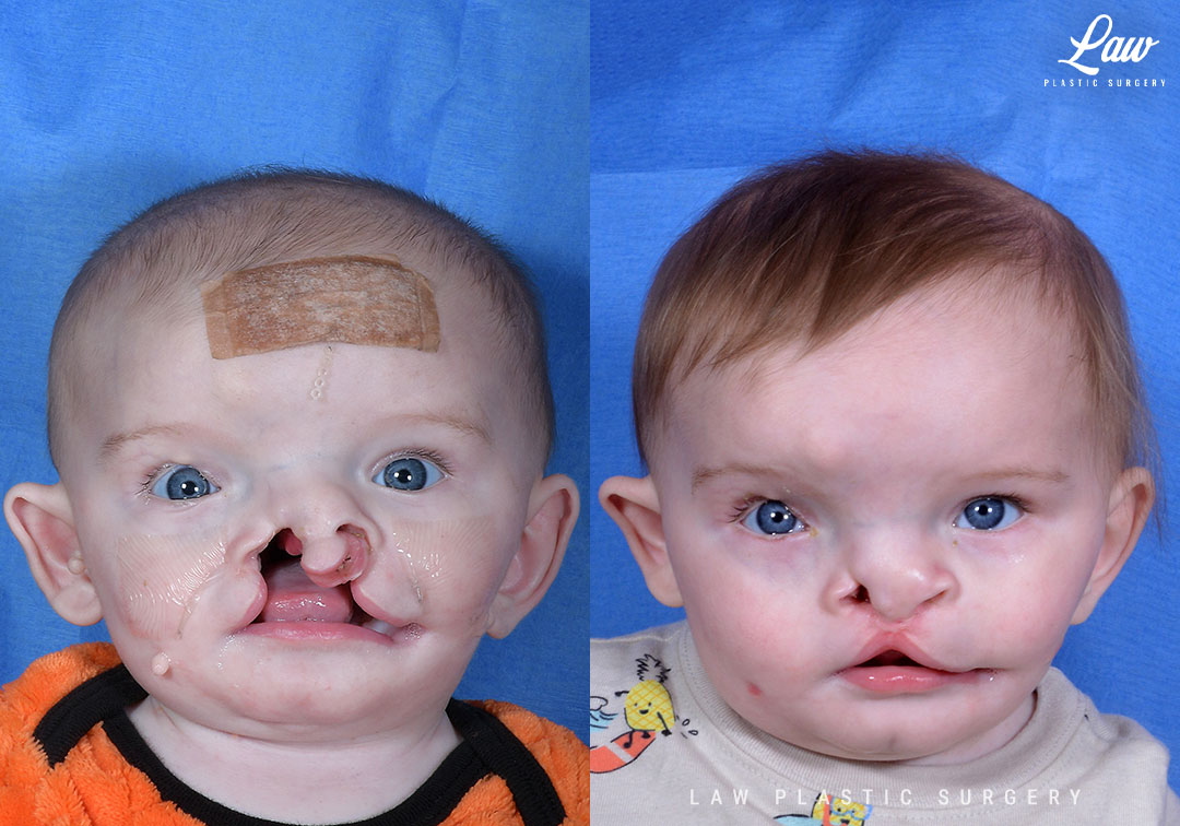Cleft Lip Repair Before & After Photo. Surgery performed in Dallas, TX at Law Plastic Surgery.