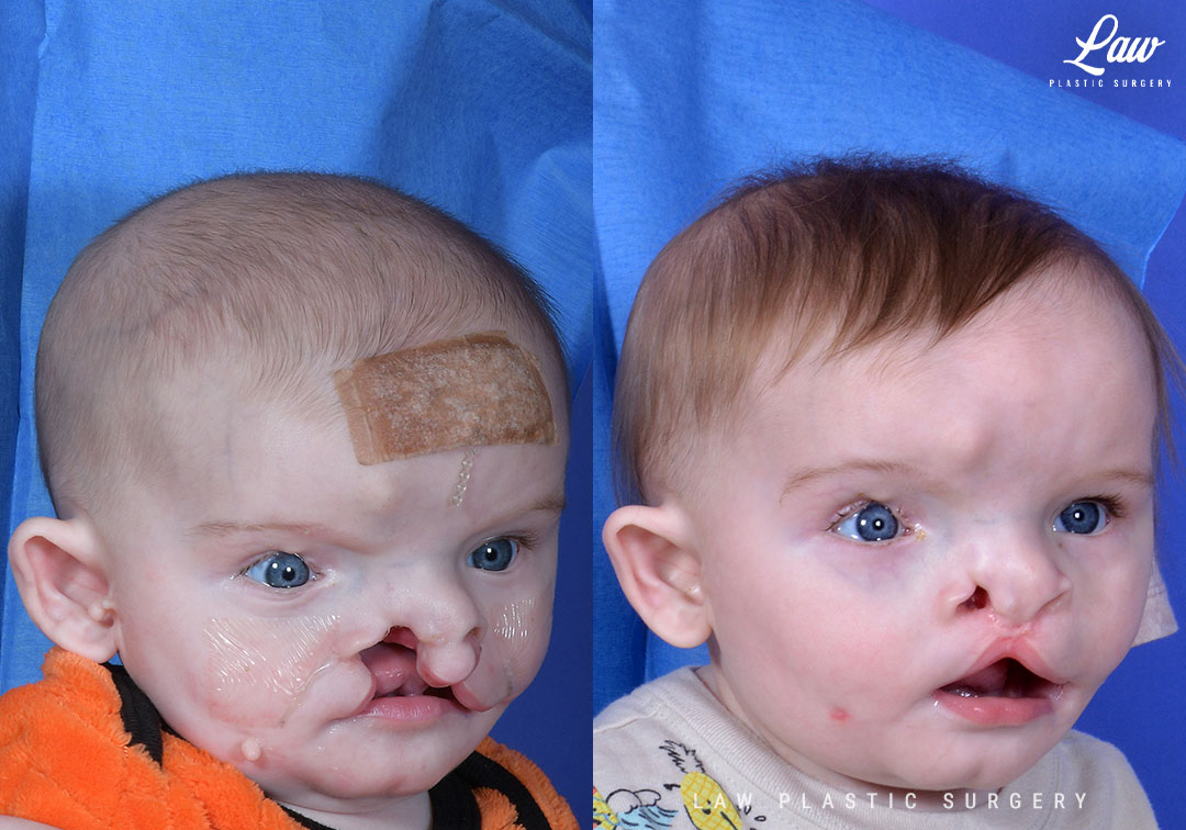 Cleft Lip Repair Before & After Photo. Surgery performed in Dallas, TX at Law Plastic Surgery.