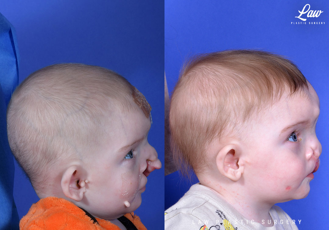 Cleft Lip Repair Before & After Photo. Surgery performed in Dallas, TX at Law Plastic Surgery.