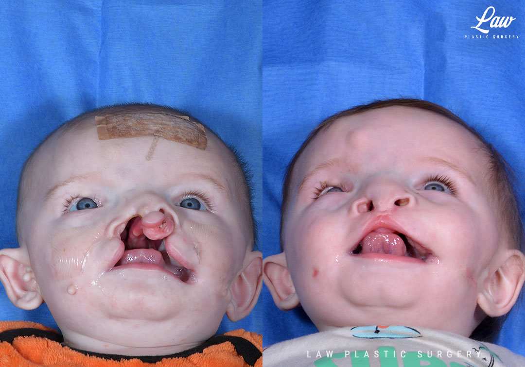 Cleft Lip Repair Before & After Photo. Surgery performed in Dallas, TX at Law Plastic Surgery.