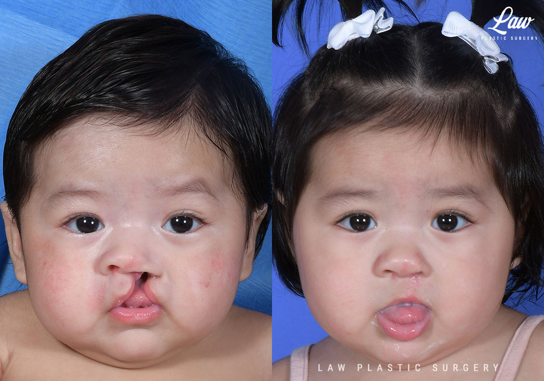 Cleft Lip Repair Before & After Photo. Surgery performed in Dallas, TX at Law Plastic Surgery.