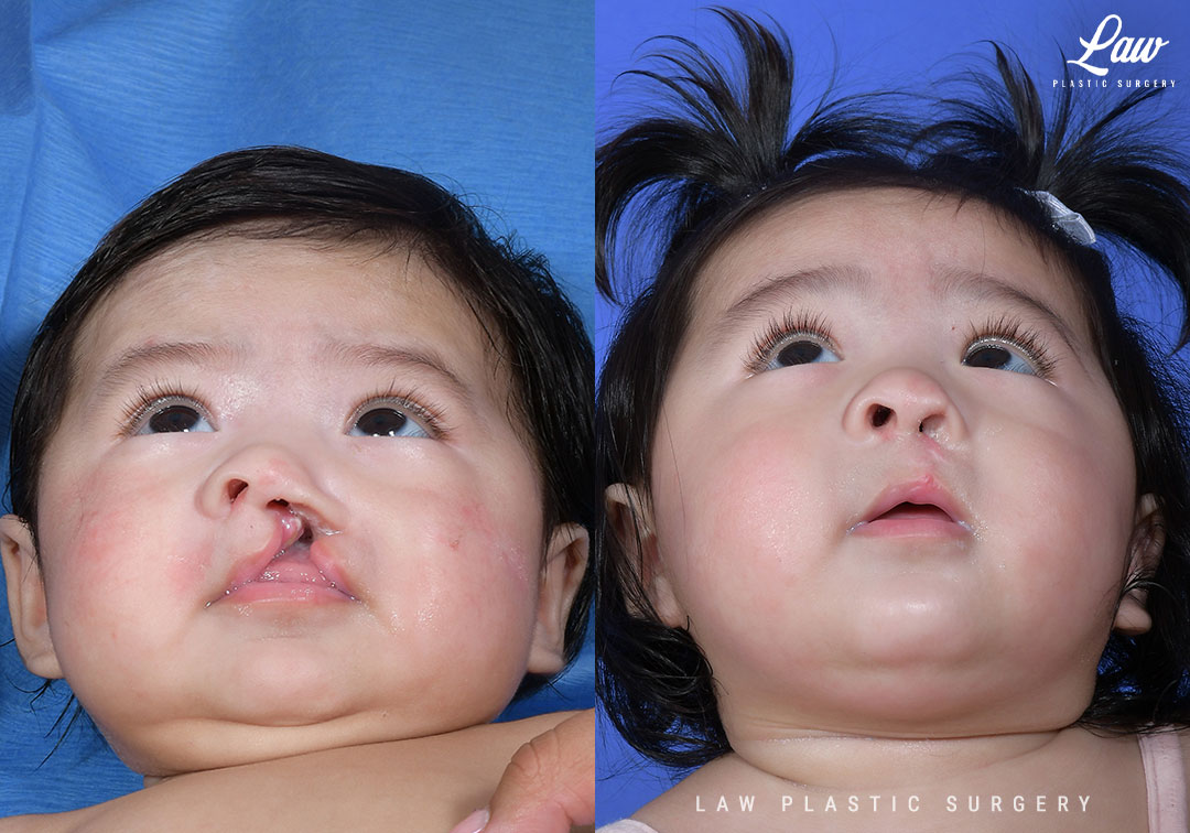 Cleft Lip Repair Before & After Photo. Surgery performed in Dallas, TX at Law Plastic Surgery.