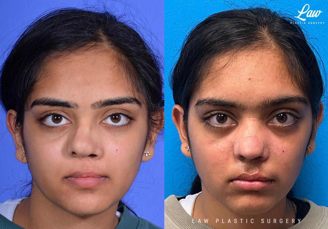 Cleft Rhinoplasty (Cleft Nose Surgery) Before & After Photo. Surgery performed in Dallas, TX at Law Plastic Surgery.