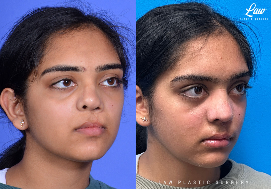 Cleft Rhinoplasty (Cleft Nose Surgery) Before & After Photo. Surgery performed in Dallas, TX at Law Plastic Surgery.