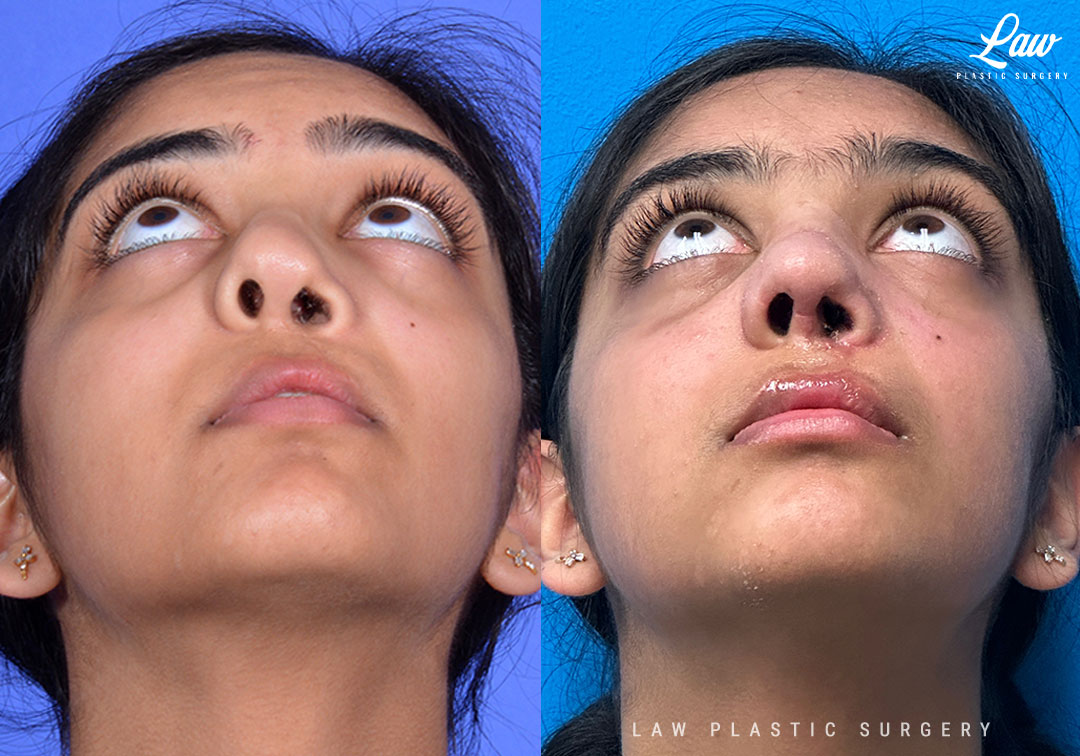 Cleft Rhinoplasty (Cleft Nose Surgery) Before & After Photo. Surgery performed in Dallas, TX at Law Plastic Surgery.