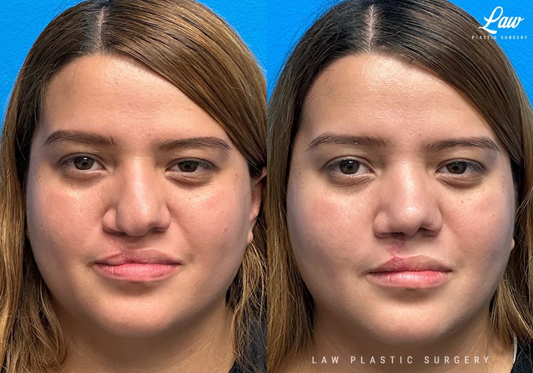 Cleft Rhinoplasty (Cleft Nose Surgery) Before & After Photo. Surgery performed in Dallas, TX at Law Plastic Surgery.