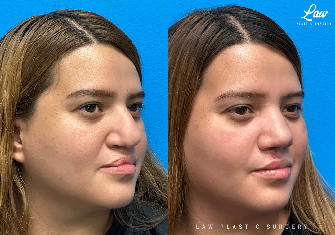 Cleft Rhinoplasty (Cleft Nose Surgery) Before & After Photo. Surgery performed in Dallas, TX at Law Plastic Surgery.