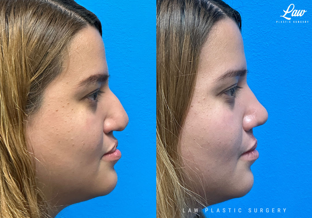 Cleft Rhinoplasty (Cleft Nose Surgery) Before & After Photo. Surgery performed in Dallas, TX at Law Plastic Surgery.