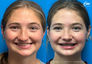 Cleft Rhinoplasty (Cleft Nose Surgery) Before & After Photo. Surgery performed in Dallas, TX at Law Plastic Surgery.