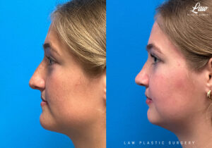 Cleft Rhinoplasty (Cleft Nose Surgery) Before & After Photo. Surgery performed in Dallas, TX at Law Plastic Surgery.