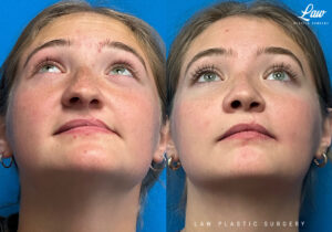 Cleft Rhinoplasty (Cleft Nose Surgery) Before & After Photo. Surgery performed in Dallas, TX at Law Plastic Surgery.