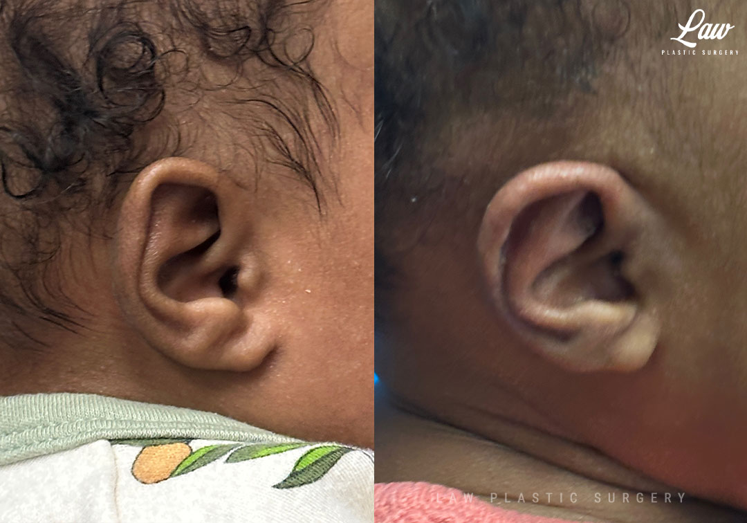Ear Molding Before and After Photo. Surgery performed in Dallas, TX at Law Plastic Surgery.